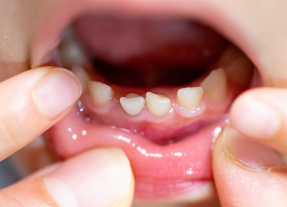 虫歯の予防