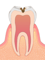 C2→虫歯の後期状態（初期）